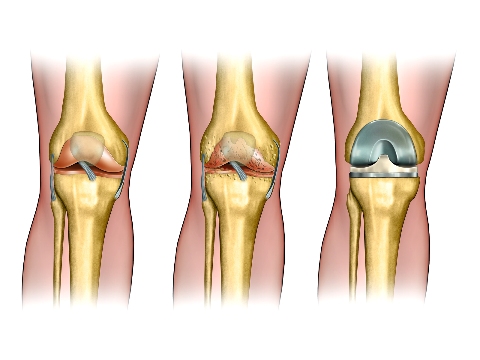 knee replacement Chhabra Hospital